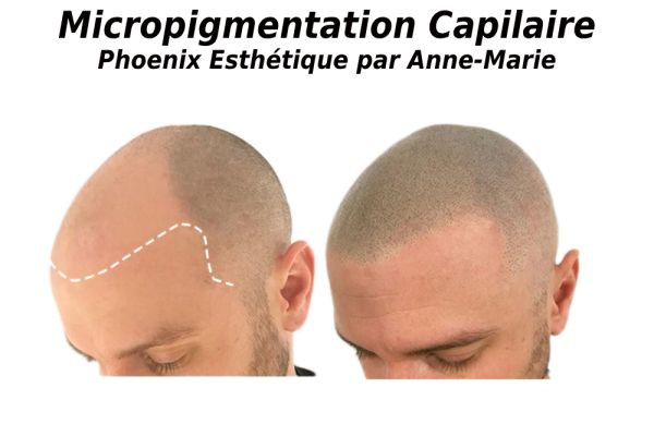 Micropigmentation capillaire à Ste-Foy : prix, séances et retouche