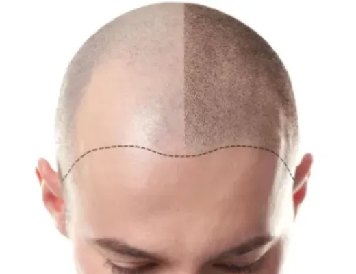 Obtenez une chevelure plus dense avec notre rabais micropigmentation capillaire